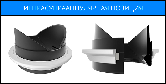 Интрасупрааннулярная позиция