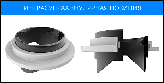 Интрасупрааннулярная позиция Интрасупрааннулярная позиция