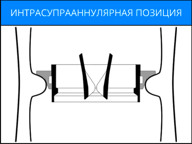 Интрасупрааннулярная позиция