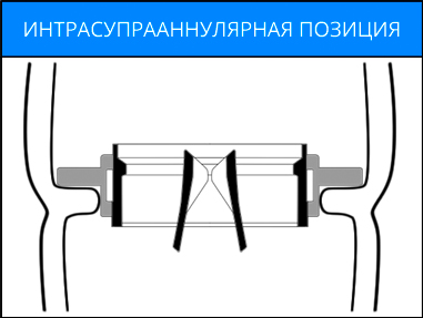 Интрасупрааннулярная позиция