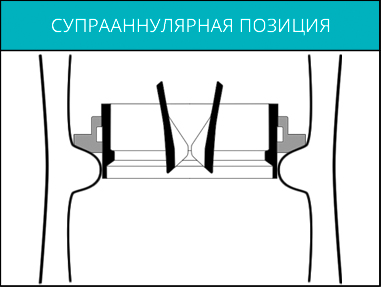 Супрааннулярная позизия