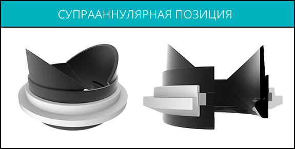 Супрааннулярная позиция Супрааннулярная позиция