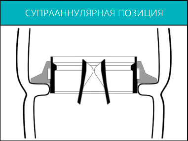 Супрааннулярная позизия